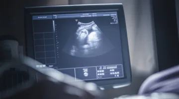 ولادة طفل يحمل جنينين في بطنه بالهند