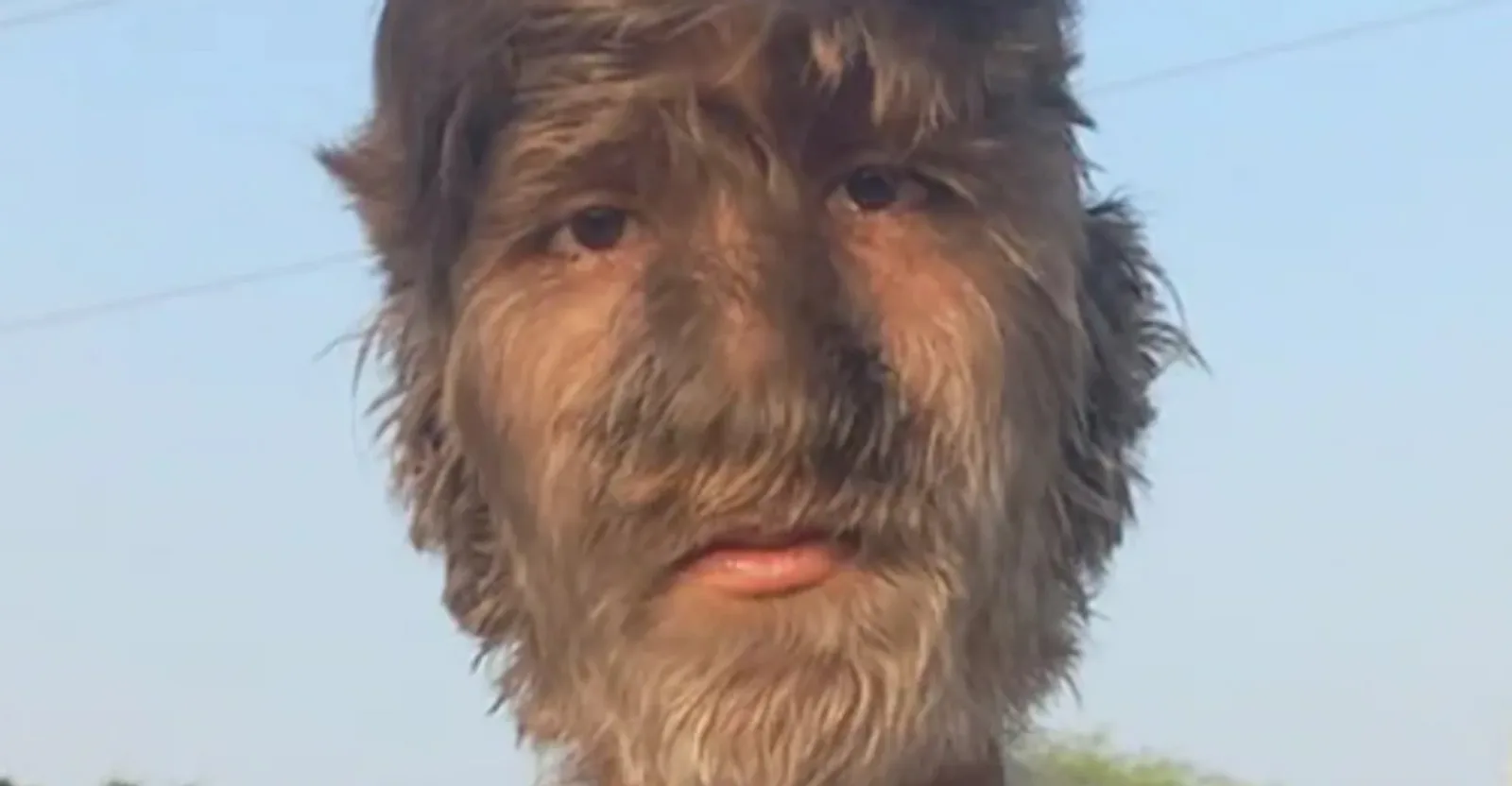 شاب يحقق رقماً قياسياً بسبب “متلازمة الذئب”