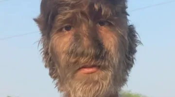 شاب يحقق رقماً قياسياً بسبب “متلازمة الذئب”